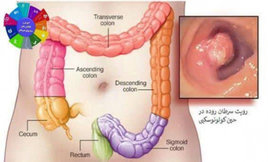 پیشگیری از سرطان روده